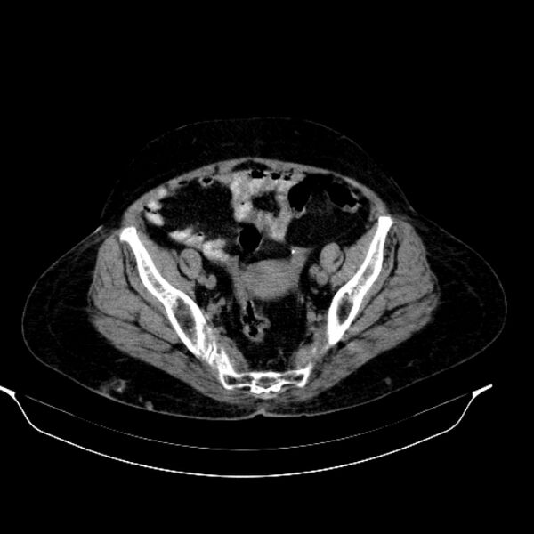 File:Calcified hydatid cyst (Radiopaedia 62000-70085 Axial non-contrast 90).jpg