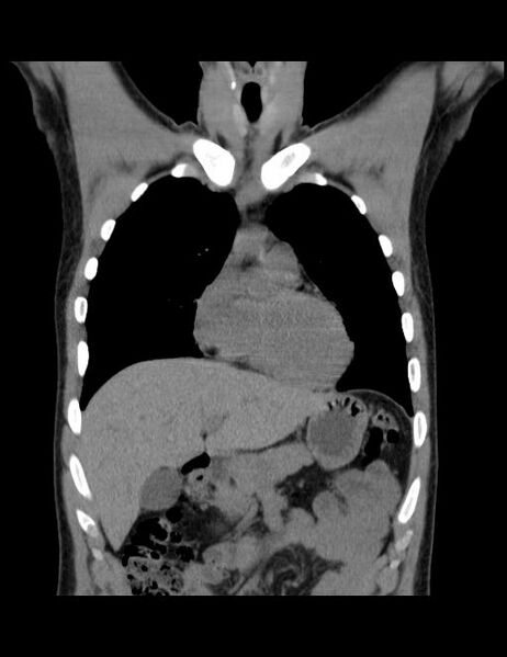File:Calcifying pulmonary metastases (Radiopaedia 33359-34396 Coronal non-contrast 33).jpg