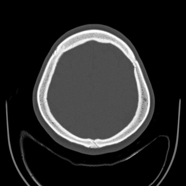File:Calvarial osteoma (Radiopaedia 36520-38079 Axial bone window 87).jpg