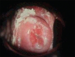 Curdy white discharge suggestive of candidiasis