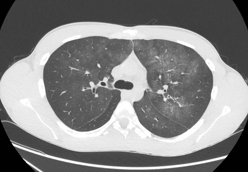 File:Cannabis-induced diffuse alveolar hemorrhage (Radiopaedia 89834-106946 Axial lung window 40).jpg