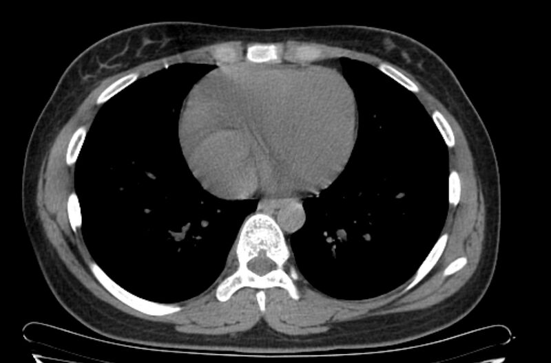 File:Cannonball metastases - uterine choriocarcinoma (Radiopaedia 70137-80173 Axial non-contrast 82).jpg