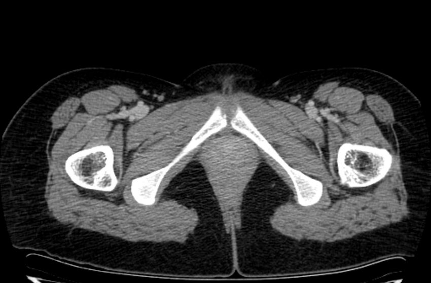 Cannonball metastases - uterine choriocarcinoma (Radiopaedia 70137-80174 A 72).jpg