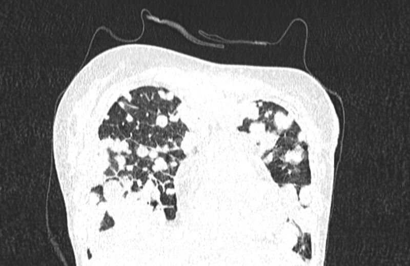 File:Cannonball metastases from breast cancer (Radiopaedia 91024-108569 Coronal lung window 29).jpg