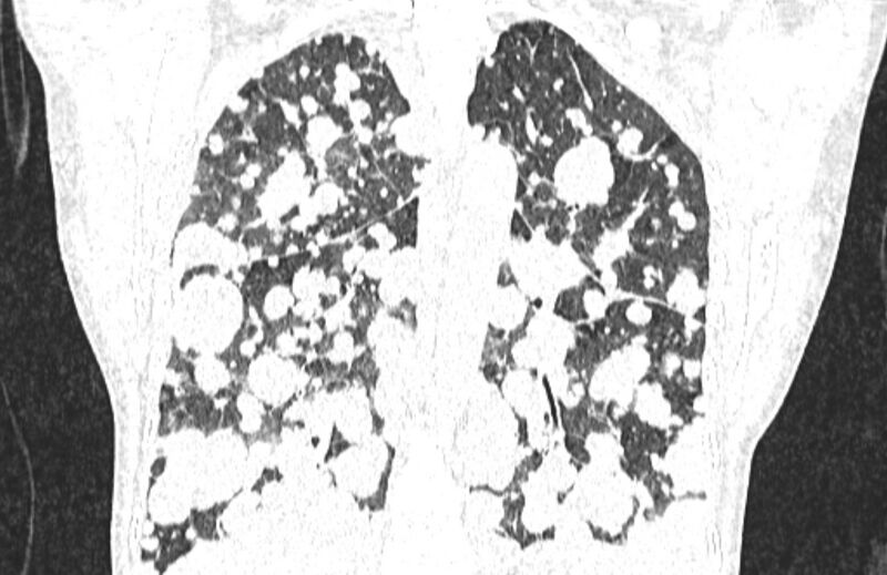 File:Cannonball metastases from breast cancer (Radiopaedia 91024-108569 Coronal lung window 97).jpg