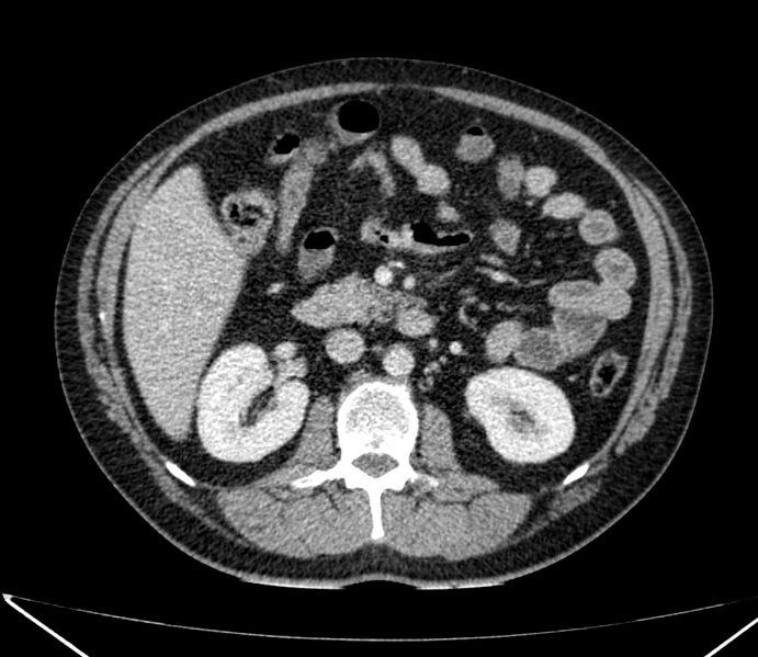 File:Carcinoid tumor with hepatic metastases (Radiopaedia 22651-22670 C 46).jpg
