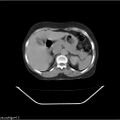 Carcinoma cervix- recurrence (Radiopaedia 34702-36137 B 65).jpg