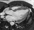 Cardiac sarcoidosis (Radiopaedia 39811-42243 LVOT cine images 17).jpg