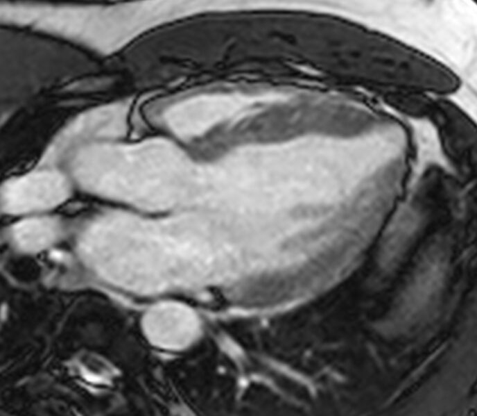 File:Cardiac sarcoidosis (Radiopaedia 39811-42243 LVOT cine images 17).jpg