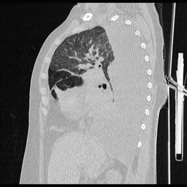 File:Cardiogenic pulmonary edema (Radiopaedia 29213-29609 Sagittal lung window 36).jpg
