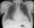 Cardiomyopathy (Radiopaedia 33212).jpg