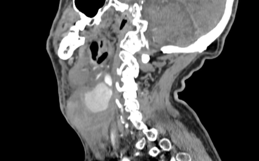 Carotid artery pseudoaneurysm (Radiopaedia 84030-99259 E 23).jpg