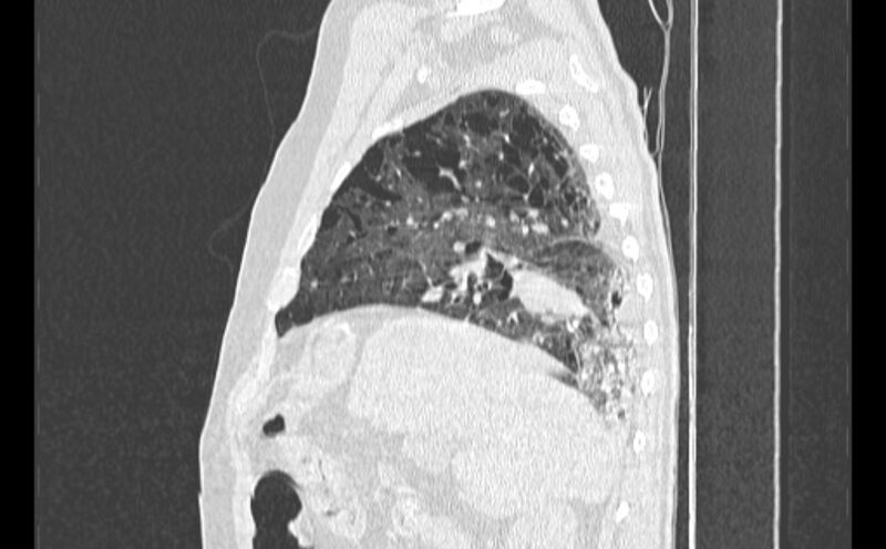 File:Cavitating bronchogenic carcinoma (Radiopaedia 44489-48162 Sagittal lung window 14).jpg