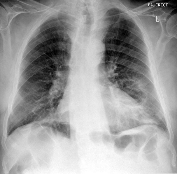 File:Cavitating left lower lobe lesion - squamous cell lung cancer (Radiopaedia 27749-27978 Frontal 1).JPG