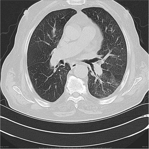 File:Cavitating left lower lobe lesion - squamous cell lung cancer (Radiopaedia 27749-28176 Axial lung window 25).jpg