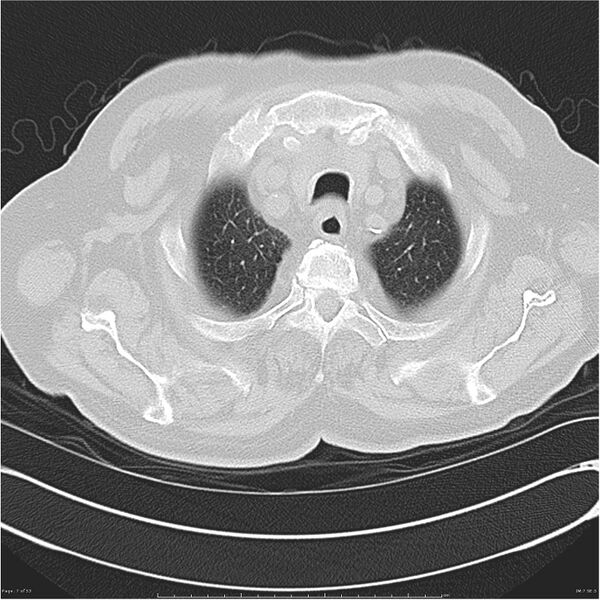 File:Cavitating left lower lobe lesion - squamous cell lung cancer (Radiopaedia 27749-28176 Axial lung window 7).jpg