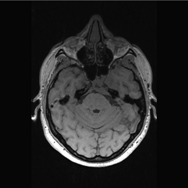File:Central base of skull meningioma (Radiopaedia 53531-59549 Axial T1 10).jpg