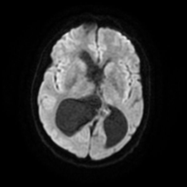 File:Central neurocytoma (Radiopaedia 67618-77021 Axial DWI 11).jpg