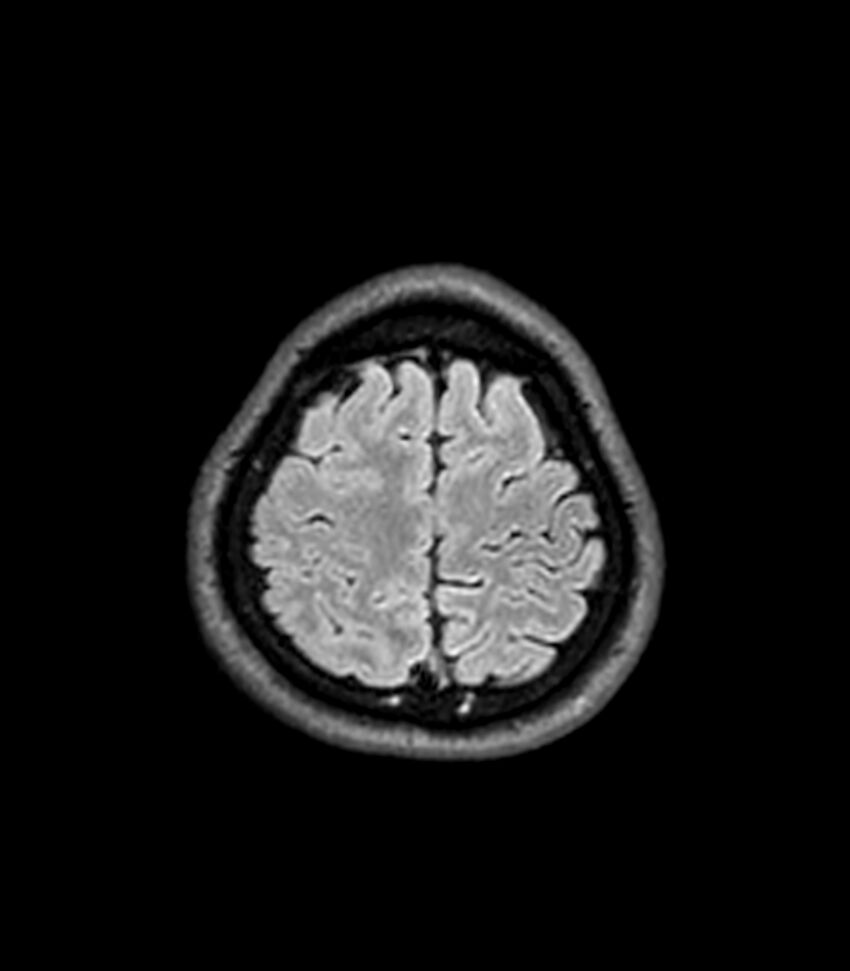 Central neurocytoma (Radiopaedia 79320-92380 Axial FLAIR 60).jpg