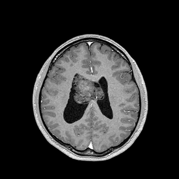 File:Central neurocytoma (Radiopaedia 79320-92380 Axial T1 C+ 158).jpg