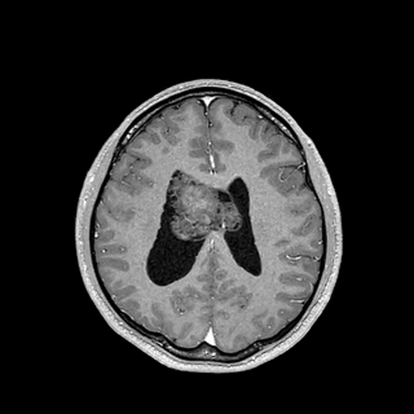 Central neurocytoma (Radiopaedia 79320-92380 Axial T1 C+ 158).jpg