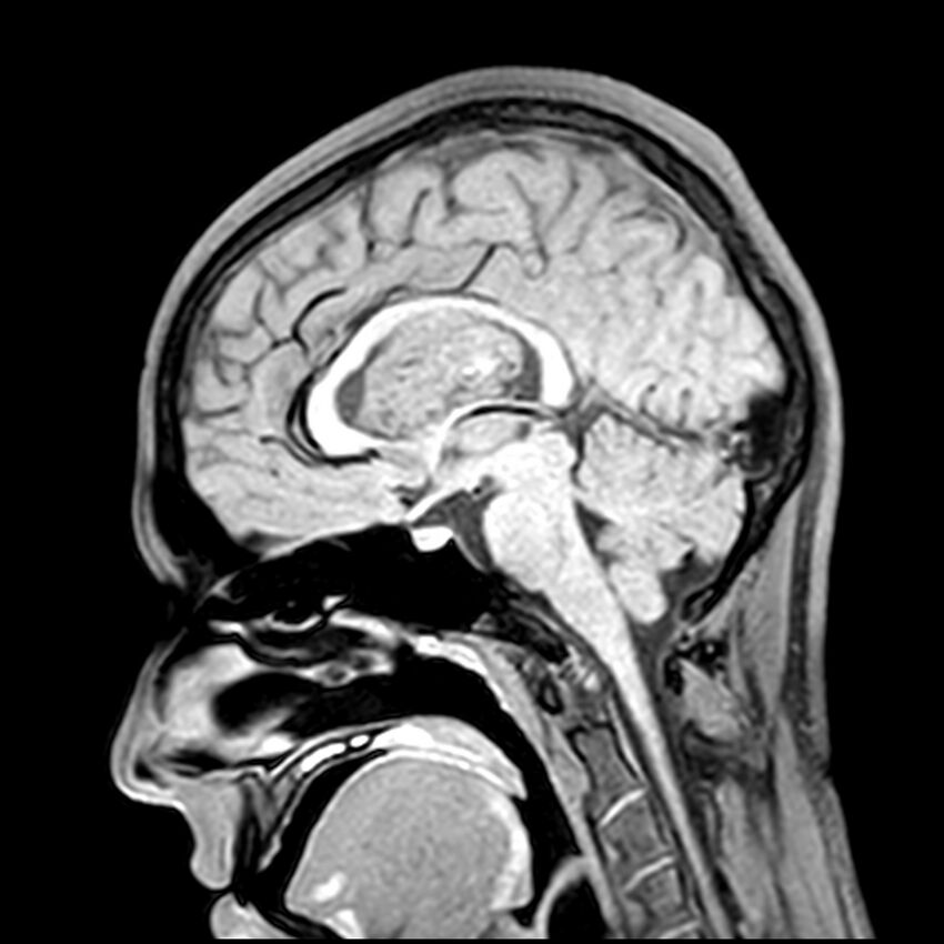 Central neurocytoma (Radiopaedia 79320-92380 Sagittal T1 127).jpg