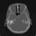 Cerebellar abscess secondary to mastoiditis (Radiopaedia 26284-26413 Axial bone window 62).jpg