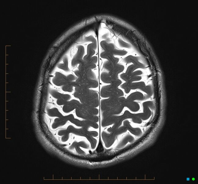 File:Cerebellar gangliocytoma (Radiopaedia 65377-74422 Axial T2 32).jpg