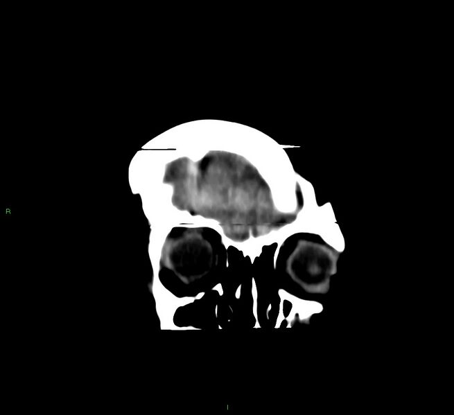 File:Cerebral amyloid angiopathy-associated lobar intracerebral hemorrhage (Radiopaedia 58377-65514 Coronal non-contrast 58).jpg