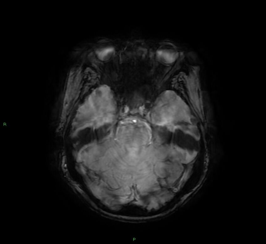 Cerebral amyloid angiopathy-associated lobar intracerebral hemorrhage (Radiopaedia 58378-65517 Axial SWI 23).jpg