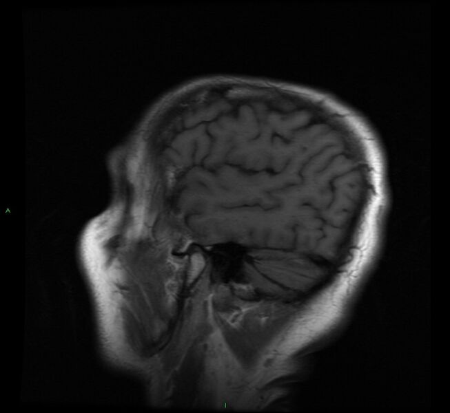 File:Cerebral amyloid angiopathy-associated lobar intracerebral hemorrhage (Radiopaedia 58529-65684 Sagittal T1 4).jpg