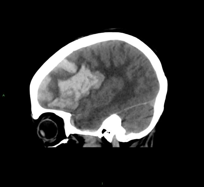 File:Cerebral amyloid angiopathy-associated lobar intracerebral hemorrhage (Radiopaedia 58561-65724 C 36).jpg