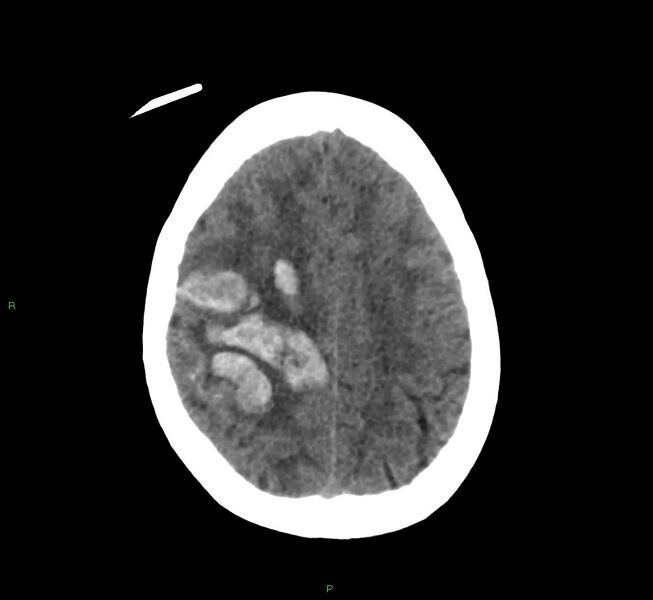 File:Cerebral amyloid angiopathy-associated lobar intracerebral hemorrhage (Radiopaedia 58566-65730 Axial non-contrast 14).jpg