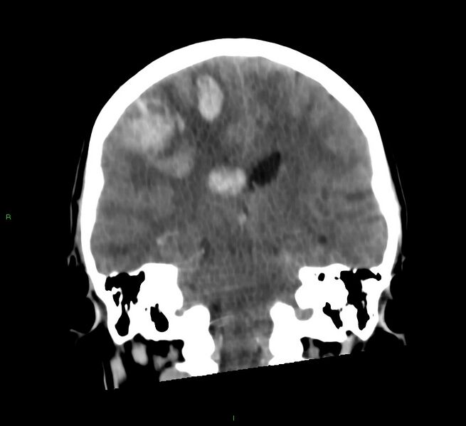 File:Cerebral amyloid angiopathy-associated lobar intracerebral hemorrhage (Radiopaedia 58566-65730 Coronal non-contrast 34).jpg