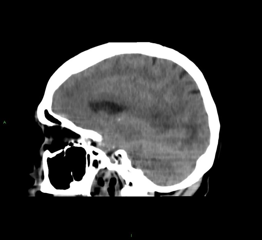 Cerebral amyloid angiopathy-associated lobar intracerebral hemorrhage (Radiopaedia 58751-65972 C 34).jpg