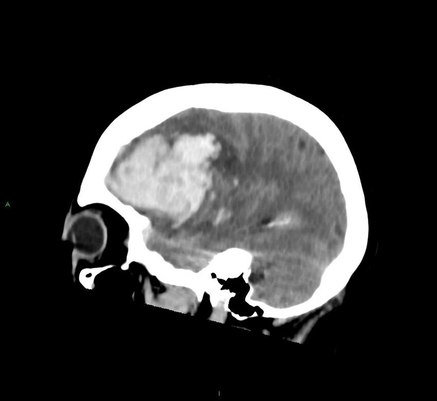 Cerebral amyloid angiopathy-associated lobar intracerebral hemorrhage (Radiopaedia 58752-65973 C 39).jpg