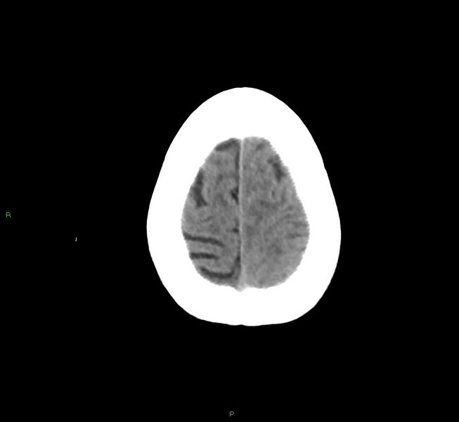 File:Cerebral amyloid angiopathy-associated lobar intracerebral hemorrhage (Radiopaedia 58754-65975 Axial non-contrast 15).jpg