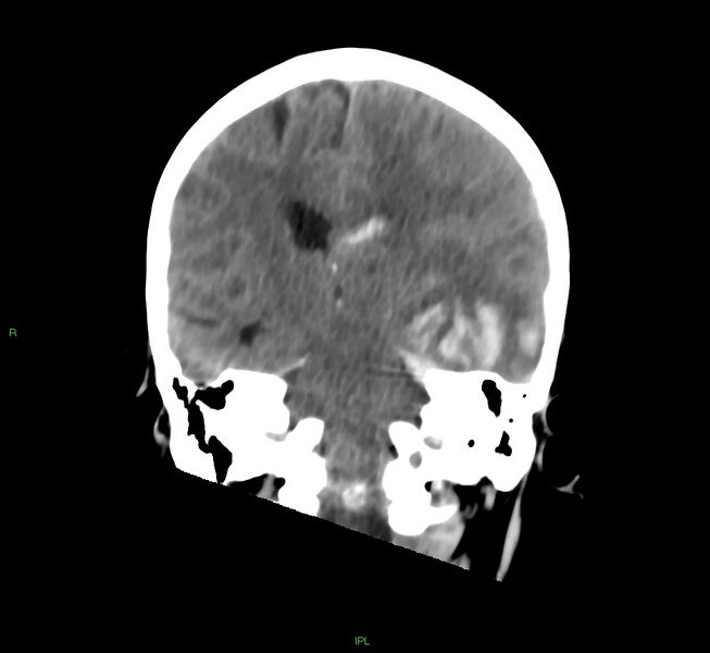 File:Cerebral amyloid angiopathy-associated lobar intracerebral hemorrhage (Radiopaedia 58754-65975 Coronal non-contrast 30).jpg