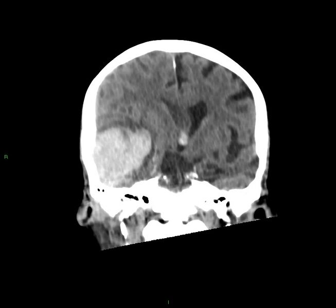 File:Cerebral amyloid angiopathy-associated lobar intracerebral hemorrhage (Radiopaedia 58758-65980 Coronal non-contrast 35).jpg