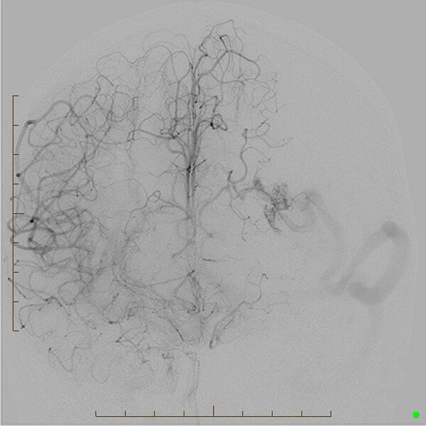 File:Cerebral arteriovenous malformation (AVM) (Radiopaedia 78162-90707 A 12).jpg