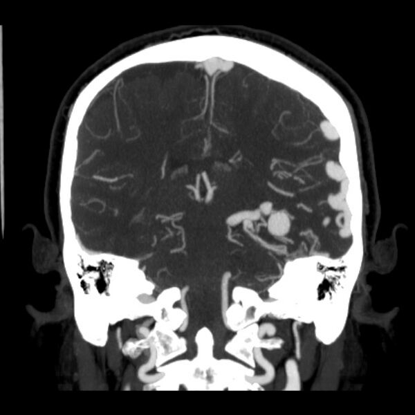 File:Cerebral arteriovenous malformation (Radiopaedia 43729-47189 C 29).jpg