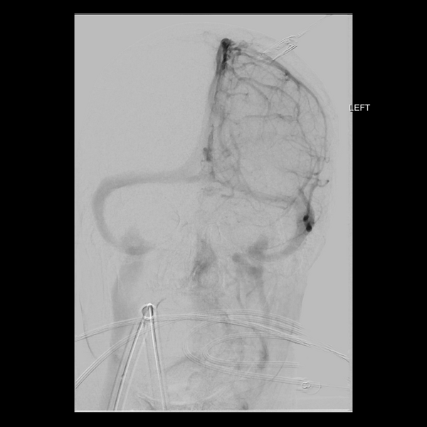 File:Cerebral arteriovenous malformation with lobar hemorrhage (Radiopaedia 44725-48513 LT CCA IC 21).png