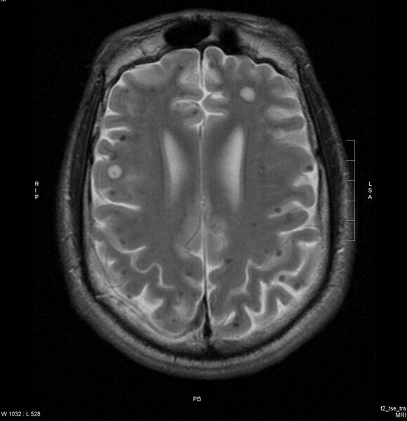 File:Cerebral coccidiomycosis (Radiopaedia 3954-6517 Axial T2 1).jpg
