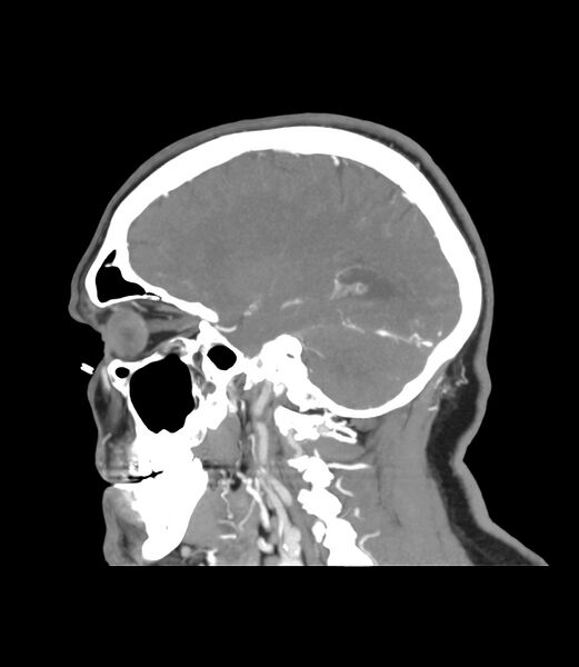 File:Cerebral dural venous sinus thrombosis (Radiopaedia 86514-102576 C 40).jpg