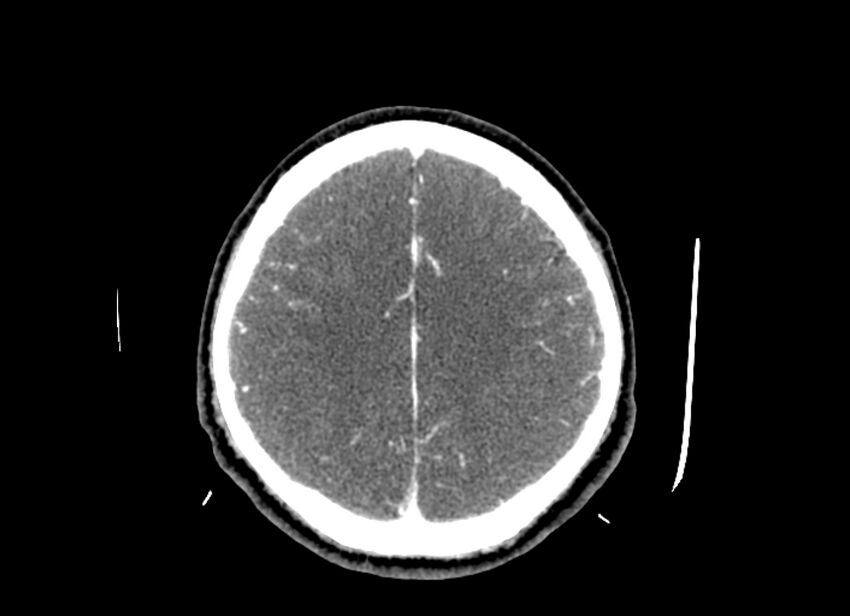 Cerebral edema (Radiopaedia 82519-96661 B 19).jpg
