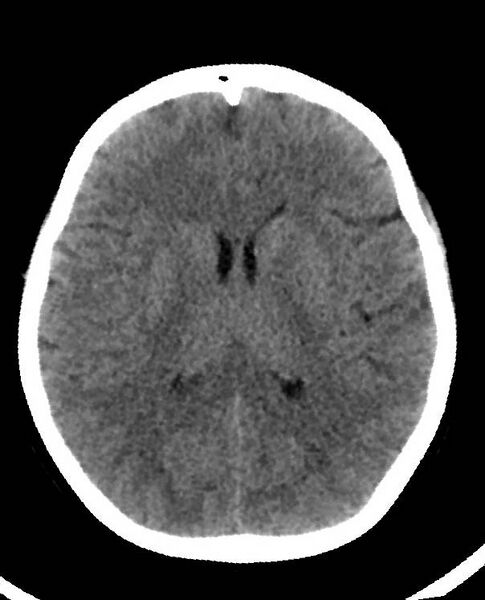 File:Cerebral edema due to severe hyponatremia (Radiopaedia 89826-106938 Axial non-contrast 58).jpg