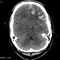 Cerebral hemorrhagic contusion with subdural and subarachnoid hemorrhage (Radiopaedia 10680-19197 Axial non-contrast 7).jpg
