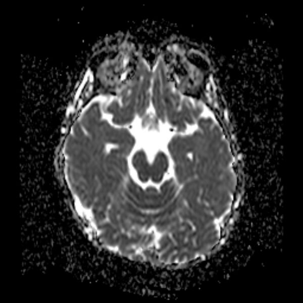 File:Cerebral tuberculoma (Radiopaedia 41152-43932 Axial ADC 8).jpg