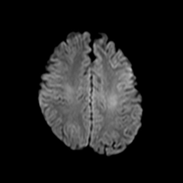 File:Cerebral tuberculoma (Radiopaedia 41152-43932 Axial DWI 17).jpg