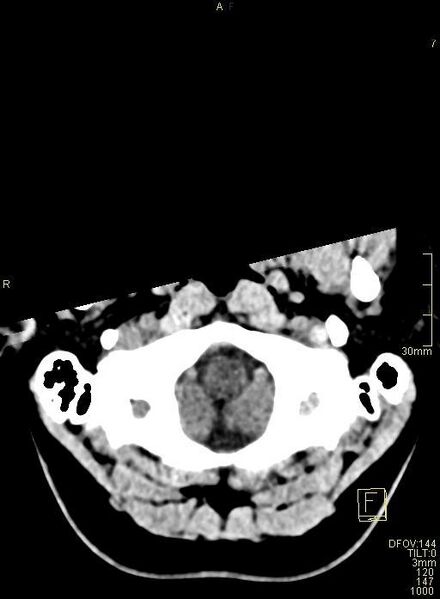 File:Cerebral venous sinus thrombosis (Radiopaedia 91329-108965 Axial non-contrast 5).jpg